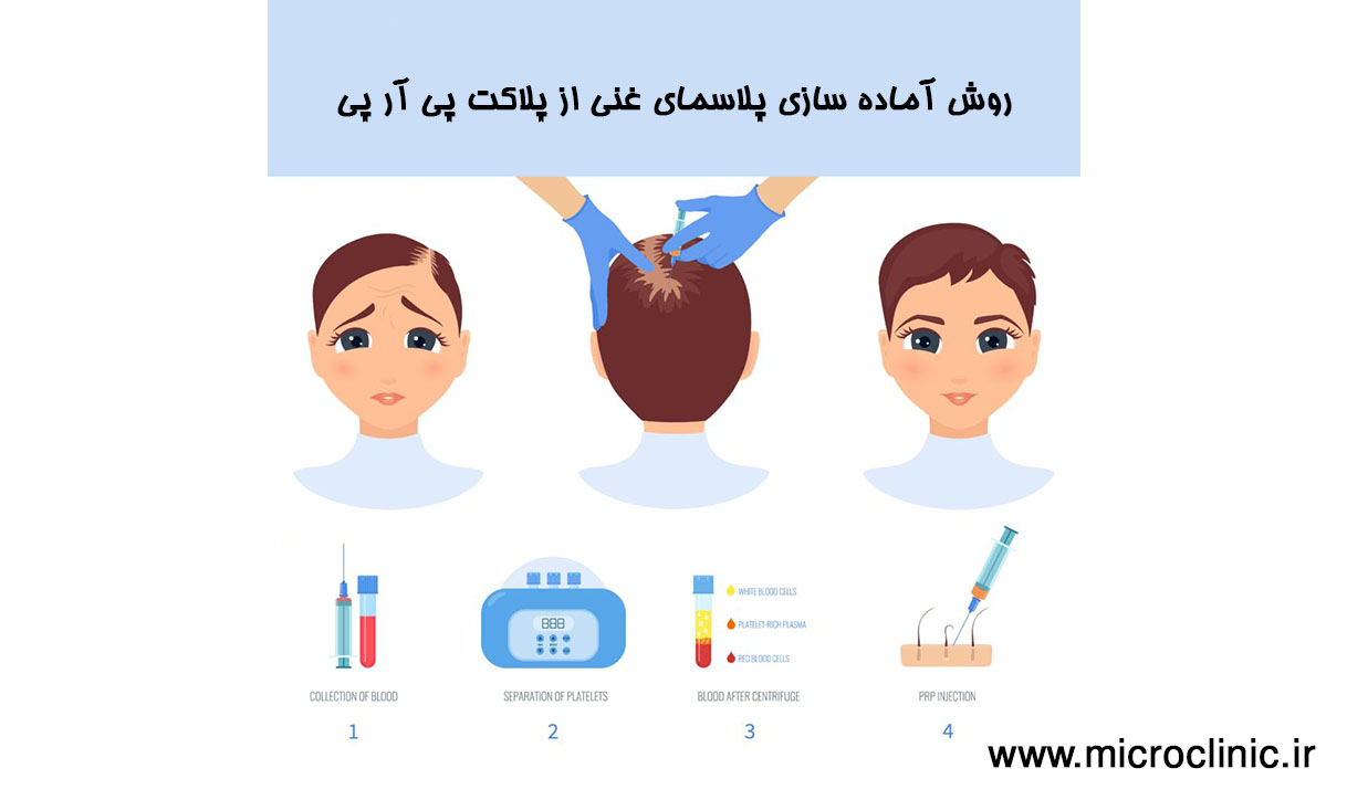 درمان ریزش مو با دو روش PRGF و PRP-میکرو کلینیک تهران